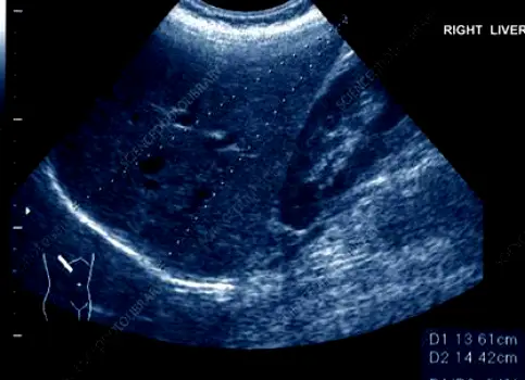 Grayscale medical ultrasound image displaying the internal structure of a liver