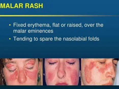 Facial rash covering the cheeks and nose bridge while leaving the skin creases beside the nose clear and unaffected