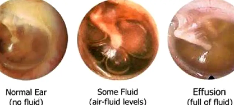 Side cutaway of an ear showing fluid collected behind the eardrum in the middle ear space