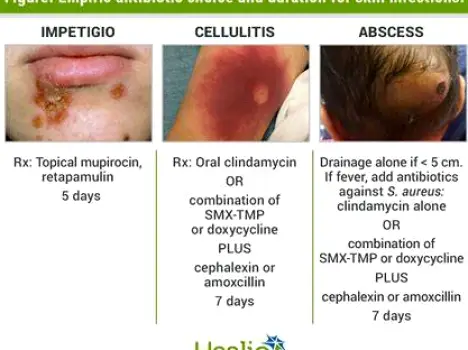 Person's arm displaying a mild skin rash after taking amoxicillin