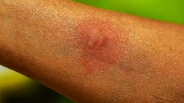 Close-up of a raised bump on a person's exposed arm.