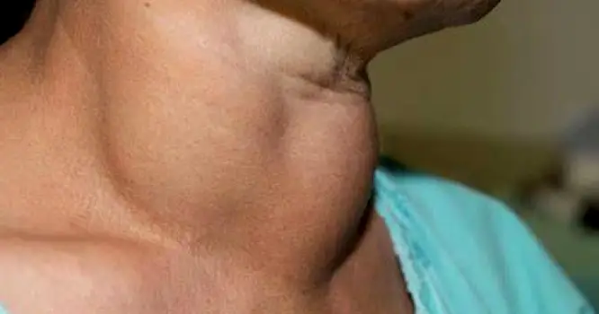 Side profile of a person's neck showing a visible swelling at the base of the neck just below the Adam's apple.