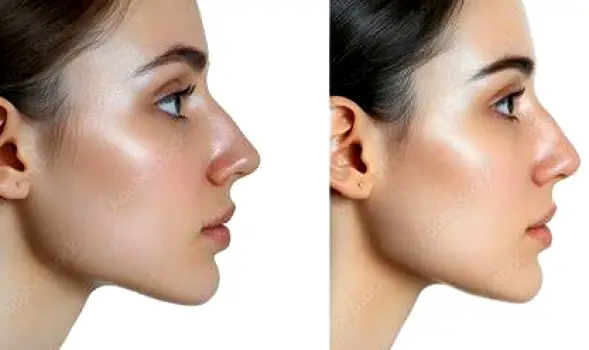 Side-by-side comparison of a nose shown from front and side viewing angles
