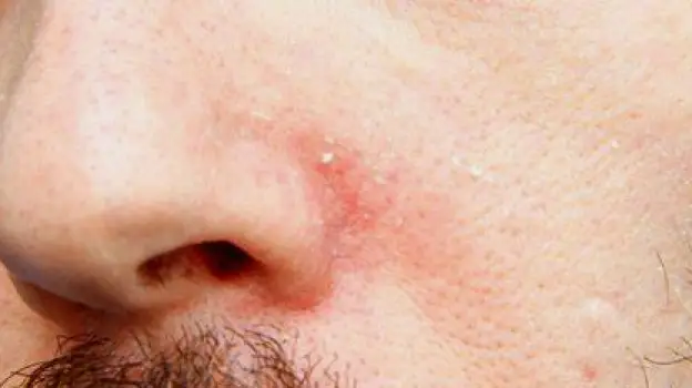 Person gently wiping the nose with a tissue while redness and chapping are visible around the nostrils