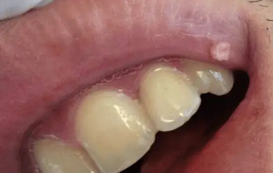 Close-up of an oral wart or papilloma appearing as a small growth on the inner lip mucosa