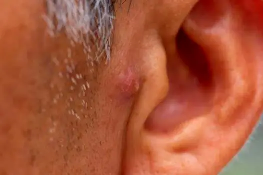 Close-up of the outer ear showing a small inflamed pimple on the earlobe