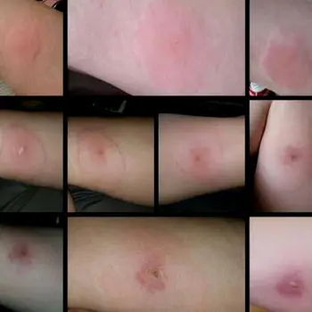 What a Parson Spider Bite May Look Like—and Its Limits