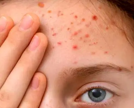 Person applying a topical acne treatment gel to the forehead, showing gentle application as described in the article.