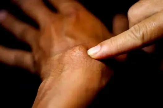 Person gently touching a swollen, painful cystic acne lesion on the jawline