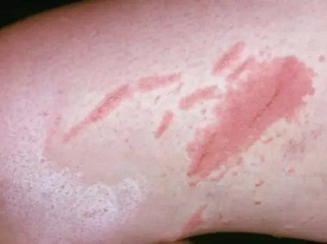 Close-up of linear streaks of raised blisters and redness on human skin