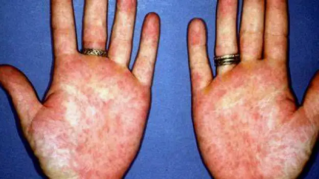 Close-up of a person's open palms showing diffuse redness across the skin