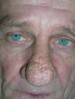 Side view of a markedly reddened nose with bulbous tissue enlargement associated with rhinophyma