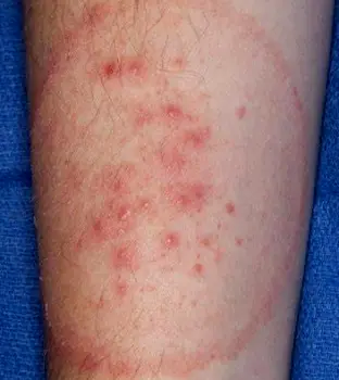 Circular scaly rash with a clear center on a human arm