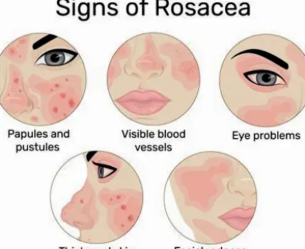 Close-up of the nose and cheeks showing persistent redness, visible blood vessels, and small inflammatory papules