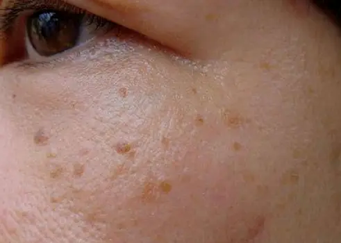 Waxy brown seborrheic keratosis with a stuck-on appearance on facial skin