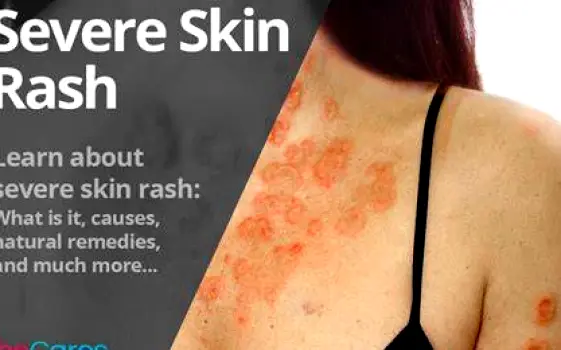 Person with severe blistering and peeling skin rash on their arm