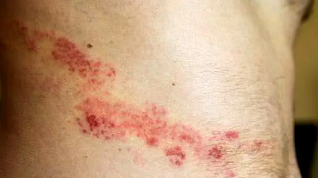 Fluid-filled blistering shingles rash forming a band on one side of a person's body
