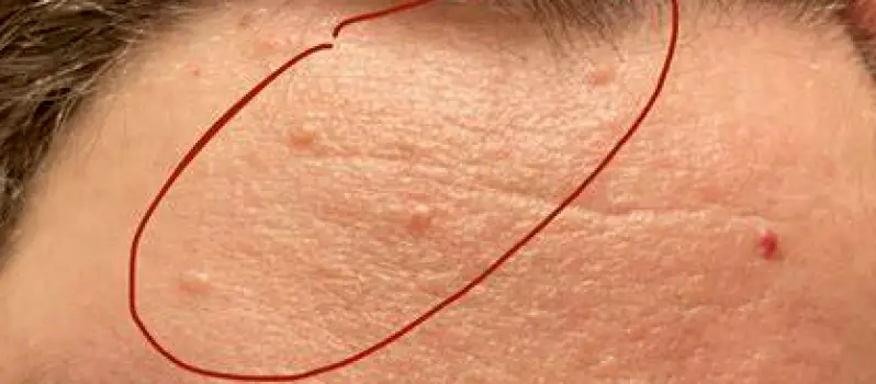 Skin-Colored Bumps on the Forehead: Causes and Next Steps