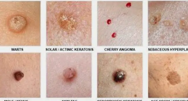 Inflamed skin surrounding a raised mole showing redness and tissue damage from caustic application