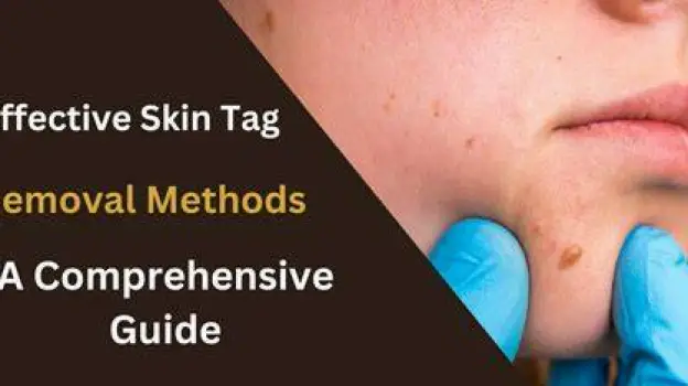 Medical illustration showing three skin tag removal techniques: cryotherapy with a freezing probe, electrosurgical destruction with a cautery tip, and excision with sterile scissors