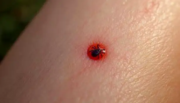 Small red or pink lump on skin showing typical local reaction to a tick bite