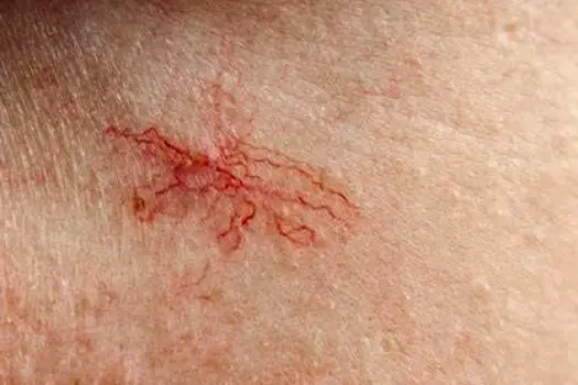 Close-up of the skin showing a cluster of visible small blood vessels forming a spider angioma
