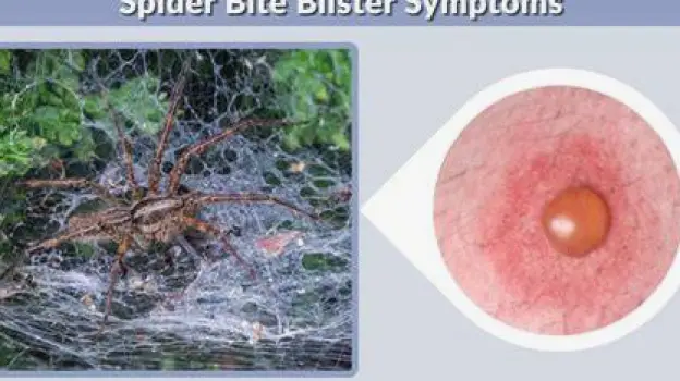 A blister on skin that has grown and broken down with surrounding discoloration spreading outward