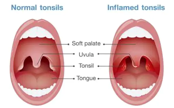 Close-up view of the back of the throat showing red, swollen tonsils with white patches of pus.