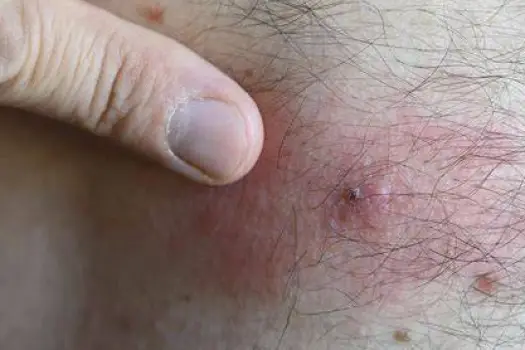 What Does a Tick Bite Look Like, and When Is It Concerning?