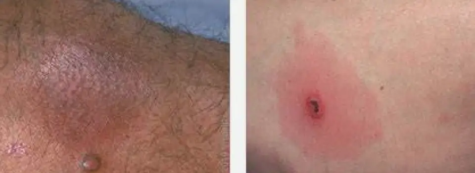 Spider Bite Appearance: Common Signs, Dangerous Reactions, and Look-Alikes