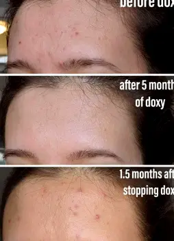 What Doxycycline Does for Acne—and What to Expect From Treatment