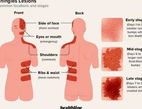 When Does Shingles Pain Peak? Timeline, Relief, and Warning Signs