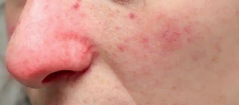 Why Is My Nose Red? Common Causes, Clues, and What to Do
