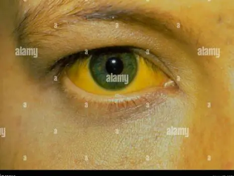 Close-up of a person's face showing yellowing of the skin and the whites of the eyes