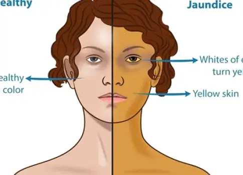 Close-up of a person's face showing yellowish tint in the skin and whites of the eyes indicating possible jaundice